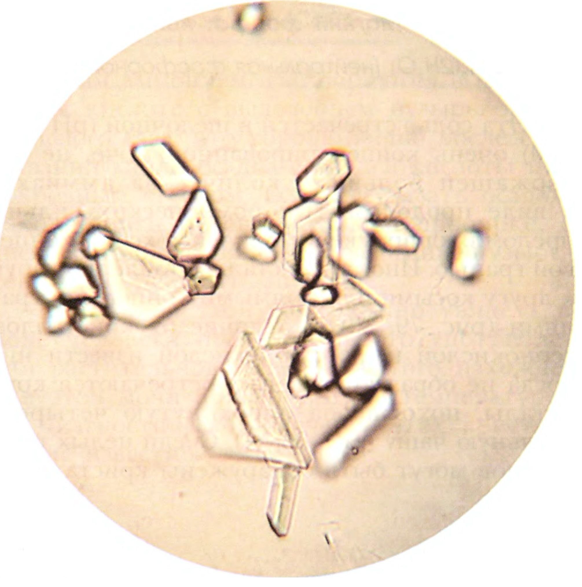 Кристаллы оксалаты в моче большое. Кристаллы магния фосфата в моче. Кальция фосфат в моче микроскопия. Струвиты микроскопия. Аморфные трипельфосфаты.