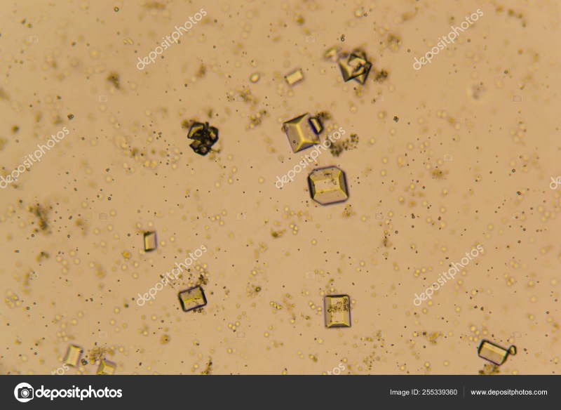 Кристаллы в моче. Кристаллы мочи под микроскопом. Коричневые Кристаллы в моче. Маленькие Кристаллы в моче. Квадратные Кристаллы в моче.
