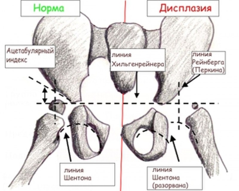 Дисплазия тазобедренных суставов этиология