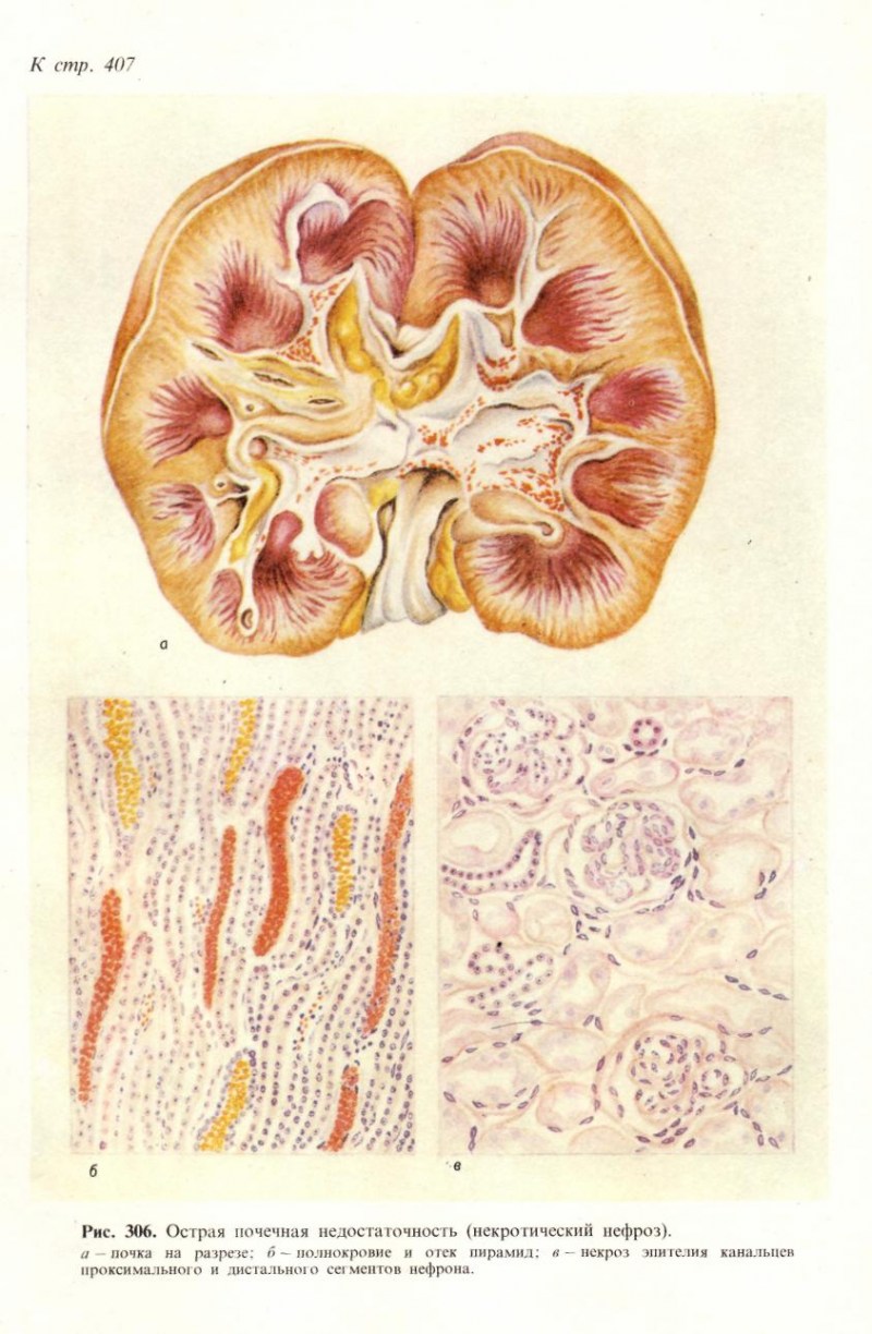 Нефроз. Некроз почечного сосочка.