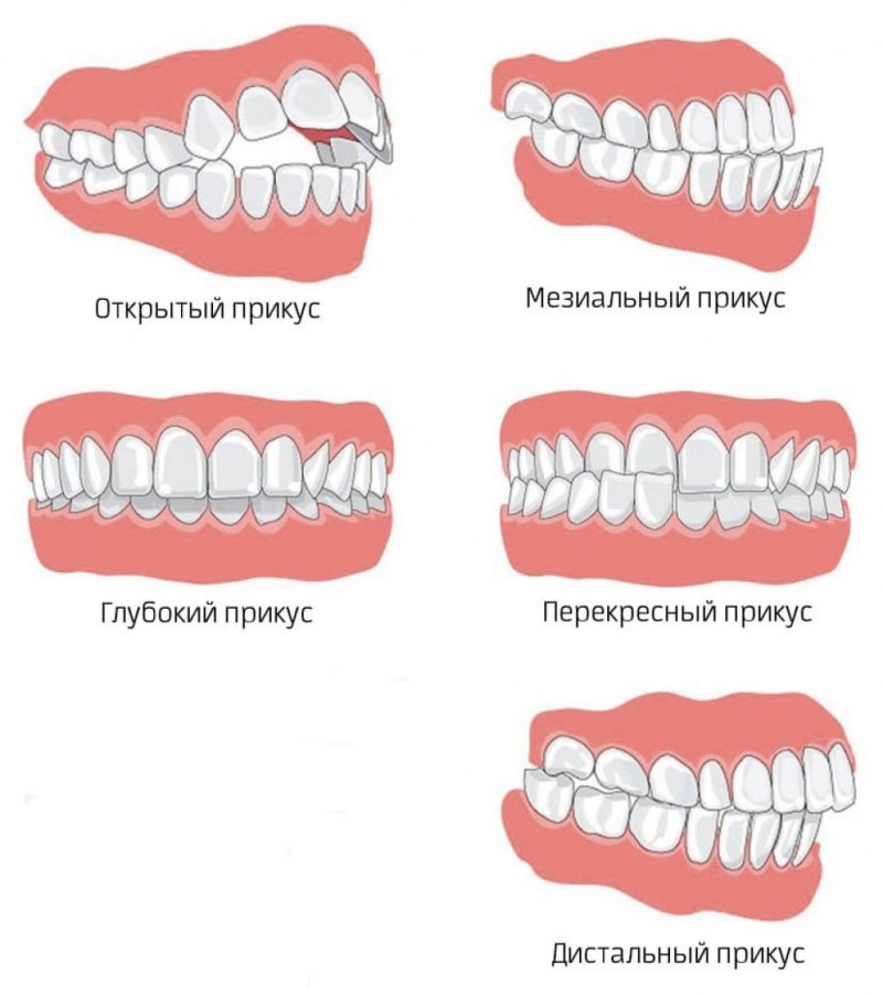 Правильный прикус у человека схема сбоку